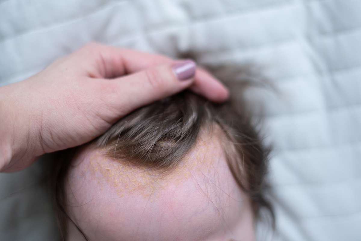 Trockene Kopfhaut Bei Babys Kopfgneis Oder Milchschorf